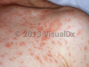 Clinical image of Pityriasis rosea - imageId=3696704. Click to open in gallery.  caption: 'Multiple erythematous papules and a larger annular plaque ("herald patch") on the chest.'