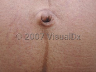 Clinical image of Linea nigra - imageId=3702199. Click to open in gallery.  caption: 'A linear brown band above and below the umbilicus.'