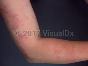 Clinical image of Urticaria - imageId=376064. Click to open in gallery.  caption: 'Edematous pink papules and plaques on the arm.'