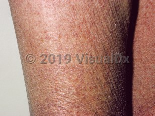 Clinical image of Acquired ichthyosis - imageId=37823. Click to open in gallery.  caption: 'Diffuse xerosis and fine adherent scales on the legs of a patient with lymphoma.'