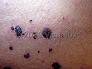 Clinical image of Bullous hemorrhagic dermatosis - imageId=3791721. Click to open in gallery.  caption: 'A close-up of numerous hemorrhagic vesicles and bullae, and early crusting, in a patient on an anticoagulant.'