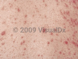 Clinical image of Neutrophilic eccrine hidradenitis - imageId=3839. Click to open in gallery.  caption: 'A close-up of showers of small erythematous papules.'