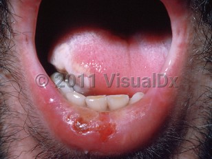 Clinical image of Drug-induced oral ulcer - imageId=387739. Click to open in gallery.  caption: 'Crusted erosions on the lower lip and a slough-covered ulcer on the tongue.'