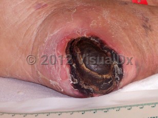 Clinical image of Unstageable pressure injury - imageId=3969180. Click to open in gallery.  caption: 'A deep ulcer covered by a thick eschar on the heel.'