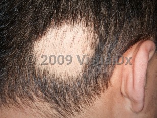 Clinical image of Alopecia areata - imageId=3997565. Click to open in gallery.  caption: 'A smooth round patch of nonscarring alopecia on the occipital scalp with early hair regrowth after intralesional steroid injection.'