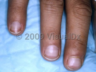 Clinical image of Terry nails - imageId=4037481. Click to open in gallery.  caption: 'Pallor of the fingernails, sparing the distal 2mm where a brown band is seen.'
