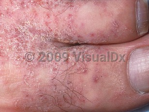 Clinical image of Crusted scabies - imageId=403777. Click to open in gallery.  caption: 'Excoriated plaques with fine white scales around the first toe web.'