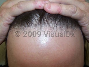 Clinical image of Frontal fibrosing alopecia - imageId=4055699. Click to open in gallery.  caption: 'A band of scarring alopecia at the anterior scalp line with few remaining hairs in scarred areas (the "lonely hair" sign). There is significant perifollicular scale and some erythema on the scalp posterior to this band.'