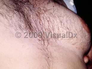 Clinical image of Klinefelter syndrome - imageId=4082024. Click to open in gallery.  caption: 'Gynecomastia.'