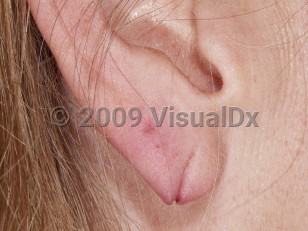 Clinical image of Torn earlobe - imageId=4141447. Click to open in gallery.  caption: '<span>Fully healed earlobe tear from 17 years ago.</span>'