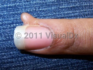 Clinical image of Acquired digital fibrokeratoma - imageId=4157375. Click to open in gallery.  caption: 'Smooth, skin-colored, pedunculated papule on the lateral nail fold of the digit. Minimal onycholysis is present.'