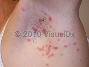 Clinical image of Guttate psoriasis - imageId=4158773. Click to open in gallery.  caption: 'Well-demarcated salmon-pink scaly papules, some confluent, in the axilla.'