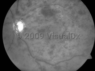 Clinical image of Central retinal vein occlusion - imageId=4174932. Click to open in gallery. 