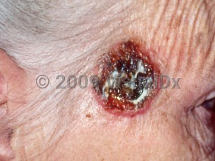 Clinical image of Atypical fibroxanthoma - imageId=4211299. Click to open in gallery.  caption: 'An ulcerated erythematous plaque with overlying hemorrhagic crusting at the temple.'