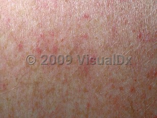 Clinical image of Dengue fever - imageId=423445. Click to open in gallery.  caption: 'A close-up of erythematous macules and papules.'