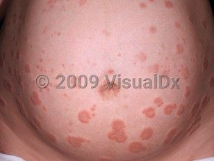 Clinical image of Pemphigoid gestationis - imageId=4240981. Click to open in gallery.  caption: 'Urticarial and targetoid papules and plaques on a pregnant belly.'