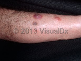 Clinical image of Mycobacterium chelonae infection - imageId=4262364. Click to open in gallery.  caption: 'Erythematous nodules, one crusted and with overlying scale, on the leg of a renal transplant patient.'
