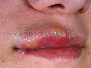 Clinical image of Orofacial herpes simplex virus - imageId=428508. Click to open in gallery.  caption: 'Grouped vesicles with a background of erythema and edema on the right upper lip.'