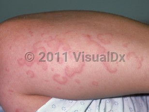 Clinical image of Urticarial vasculitis - imageId=43328. Click to open in gallery.  caption: 'Many discrete and confluent, annular and arcuate, erythematous, and edematous papules and plaques, on the arm.'