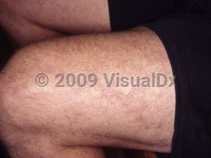 Clinical image of Sneddon syndrome - imageId=4342337. Click to open in gallery.  caption: 'Dusky retiform patches (livedo racemosa) on the thigh.'