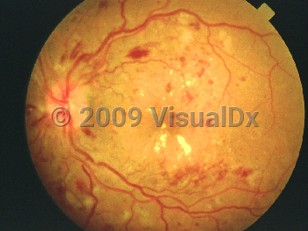 Clinical image of Diabetic retinopathy - imageId=4377187. Click to open in gallery. 