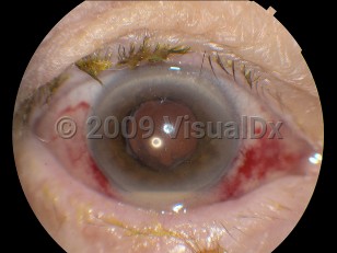 Clinical image of Endophthalmitis - imageId=4379327. Click to open in gallery. 