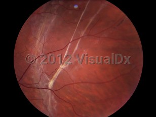 Clinical image of Retinal detachment - imageId=4381439. Click to open in gallery. 