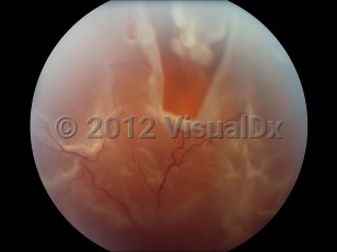 Clinical image of Retinal tear - imageId=4382977. Click to open in gallery. 