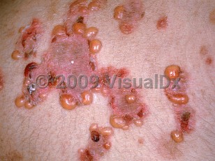 Clinical image of Linear IgA bullous dermatosis - imageId=440576. Click to open in gallery.  caption: 'A close-up of pink, scaly papules and plaques with tense vesicles and crusts at their borders.'