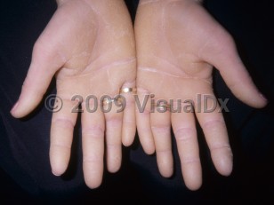 Clinical image of Howel-Evans syndrome - imageId=4433984. Click to open in gallery.  caption: 'Markedly thickened, yellowish keratotic plaques on the palms and fingers.'