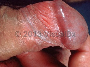 Clinical image of Bowenoid papulosis - imageId=443761. Click to open in gallery.  caption: 'Skin-colored, flat-topped verrucous papules on the penis.'