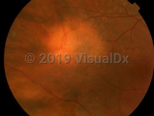 Clinical image of Choroidal nevus - imageId=4537664. Click to open in gallery.  caption: 'An amelanotic choroidal nevus, appearing as a hypopigmented patch.'
