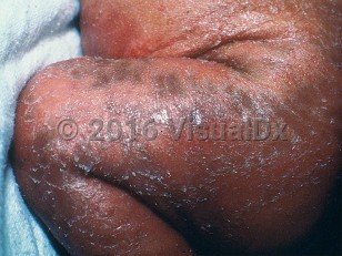 Clinical image of Conradi disease - imageId=459272. Click to open in gallery.  caption: 'Diffuse thick scales and underlying erythema on the abdomen and leg.'