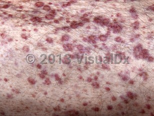 Clinical image of Multiple myeloma - imageId=4607088. Click to open in gallery. 