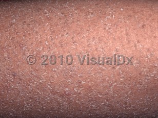 Clinical image of Xerosis - imageId=4685954. Click to open in gallery.  caption: 'A close-up of diffuse scaling.'