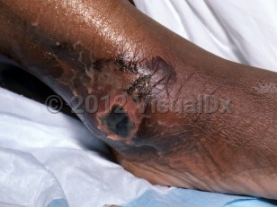 Clinical image of Necrotizing fasciitis - imageId=4708490. Click to open in gallery.  caption: 'An eschar with surrounding erosion and crusting at the ankle.'