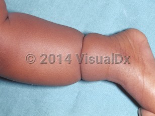 Clinical image of Amniotic band syndrome - imageId=4765439. Click to open in gallery.  caption: 'A deep constriction band around the lower leg.'
