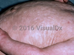 Clinical image of Congenital erosive and vesicular dermatosis - imageId=4766297. Click to open in gallery.  caption: 'Extensive hypopigmented, atrophic, reticulated scars over the trunk and arm.'