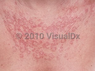Clinical image of Reticular erythematous mucinosis - imageId=4769767. Click to open in gallery.  caption: 'Numerous discrete and confluent annular, arcuate, and polycyclic papules and plaques on the chest.'