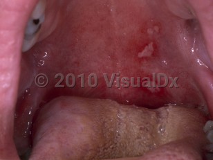 Clinical image of Herpangina - imageId=4772543. Click to open in gallery.  caption: 'Slough-covered erosions on the left palate.'