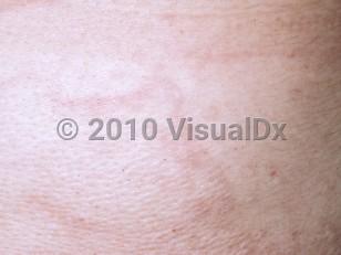 Clinical image of Mid-dermal elastolysis - imageId=4773381. Click to open in gallery.  caption: 'A close-up of subtly pink plaques with a peau d'orange appearance.'