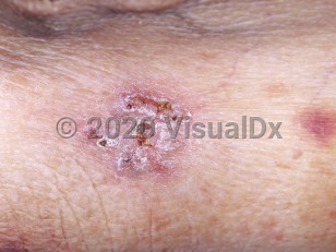 Clinical image of Alternariosis - imageId=4773799. Click to open in gallery.  caption: 'A close-up of a crusted and scaly plaque in a patient with CLL.'