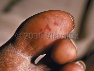 Clinical image of Endocarditis - imageId=47822. Click to open in gallery.  caption: 'Angulated reddish and violaceous macules and thin papules on the great toe.'
