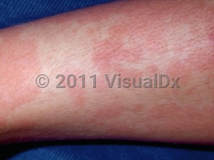 Clinical image of Serum sickness - imageId=4814. Click to open in gallery.  caption: 'Widespread thin erythematous papules and plaques on the leg.'
