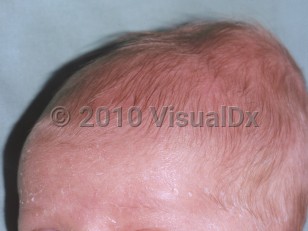 Clinical image of Cephalohematoma - imageId=4833215. Click to open in gallery.  caption: 'A mass at the vertex scalp.'