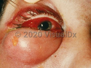 Clinical image of Preseptal cellulitis - imageId=487267. Click to open in gallery.  caption: 'Severe eyelid edema and erythema, diffuse conjunctival hemorrhage, and crusting at the canthi.'