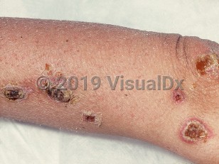 Clinical image of Mycobacterium avium-intracellulare infection - imageId=487836. Click to open in gallery.  caption: 'Numerous eroded and thickly crusted papules and plaques on the arm of an HIV-infected patient.'
