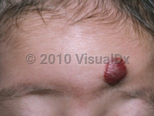 Clinical image of Infantile hemangioma - imageId=4896116. Click to open in gallery.  caption: 'A deep red nodule on the lower forehead.'