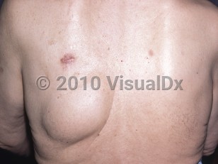 Clinical image of Hibernoma - imageId=4931648. Click to open in gallery.  caption: 'A large subcutaneous skin-colored tumor on the back.'