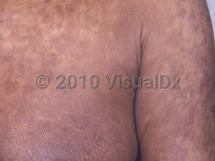 Clinical image of Angioimmunoblastic lymphadenopathy - imageId=4955382. Click to open in gallery.  caption: 'Widespread brown and violaceous, scaly plaques on the chest and arm.'